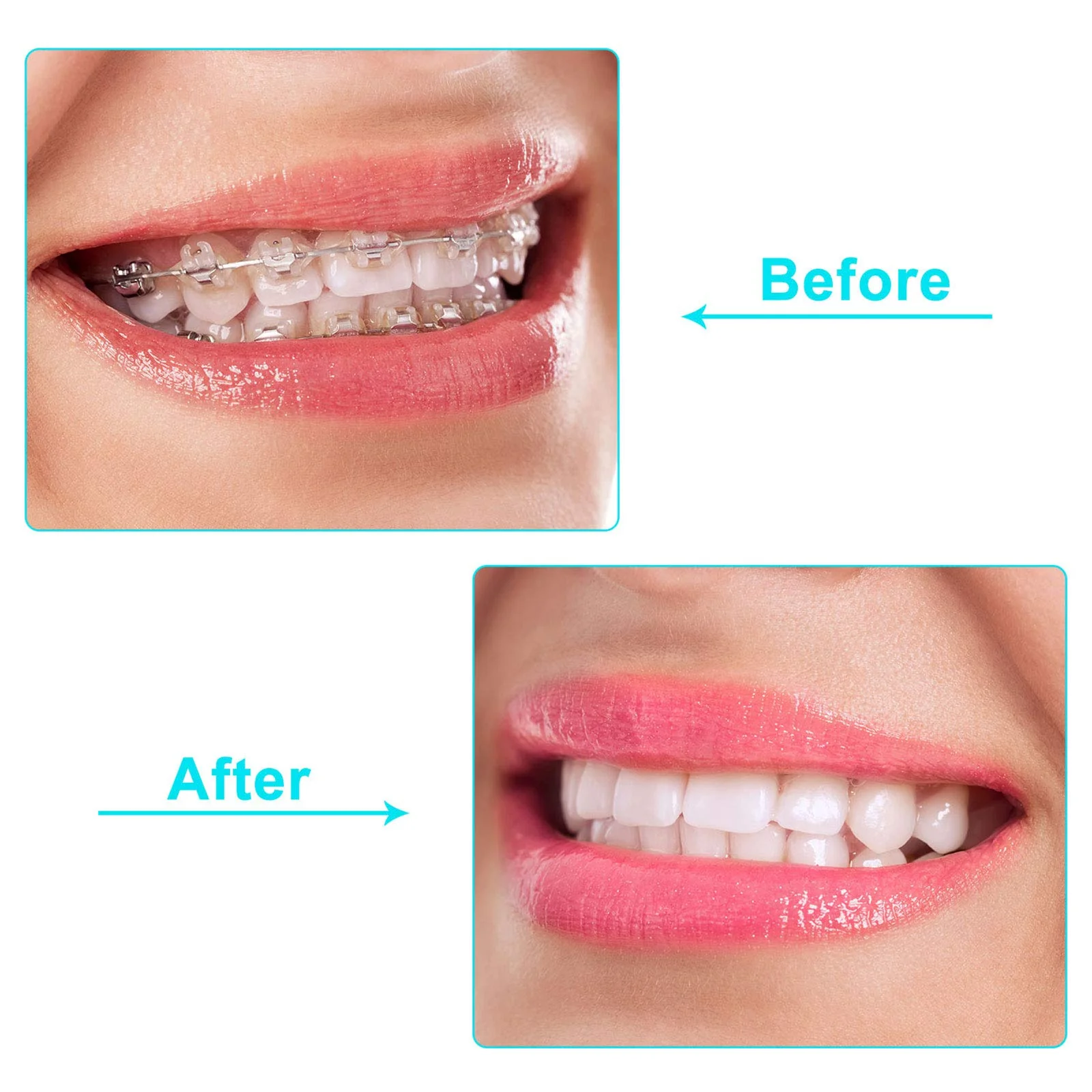BBTO 60 Pieces Aligner Tray Seaters for Chompers Orthodontic Aligner, 6 Colors - Image 6