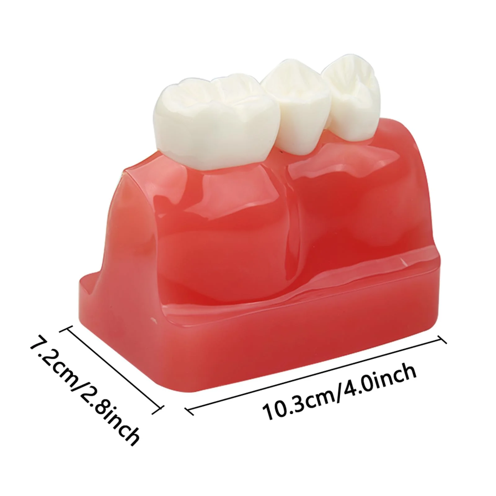 Dental Implant Model Removable Crown Bridge 4 Teeth Demonstration Model for Teaching Demonstration, Patient Education and Student Learning - Image 2
