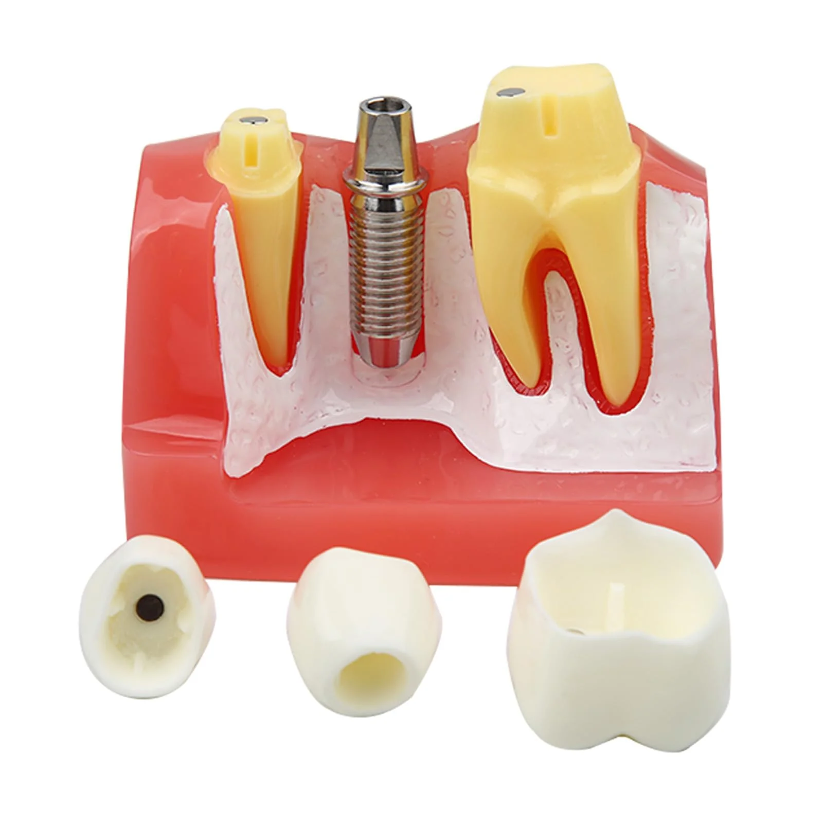 Dental Implant Model Removable Crown Bridge 4 Teeth Demonstration Model for Teaching Demonstration, Patient Education and Student Learning - Image 4