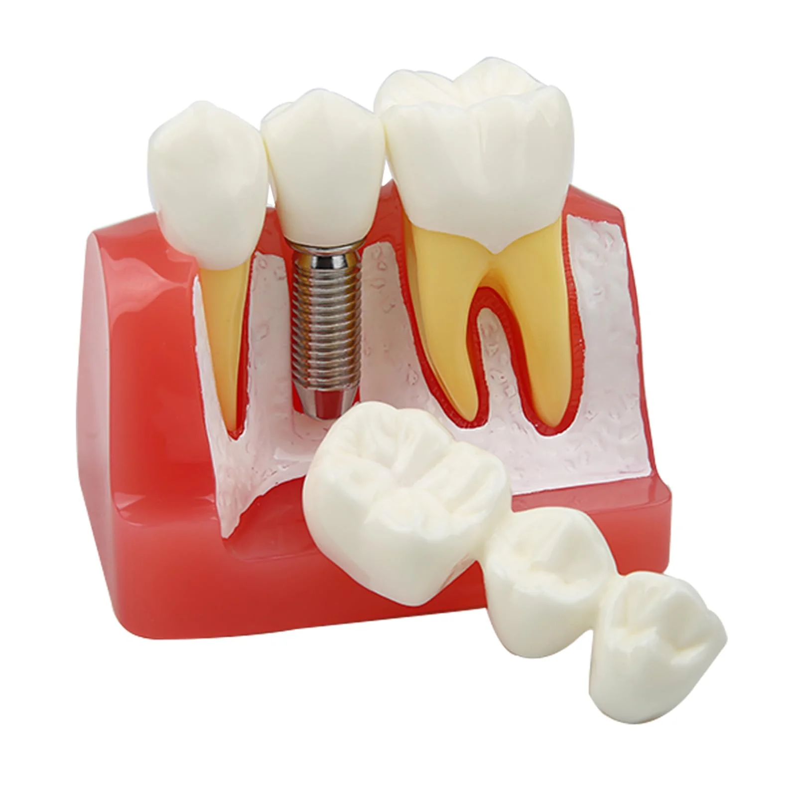 Dental Implant Model Removable Crown Bridge 4 Teeth Demonstration Model for Teaching Demonstration, Patient Education and Student Learning - Image 5