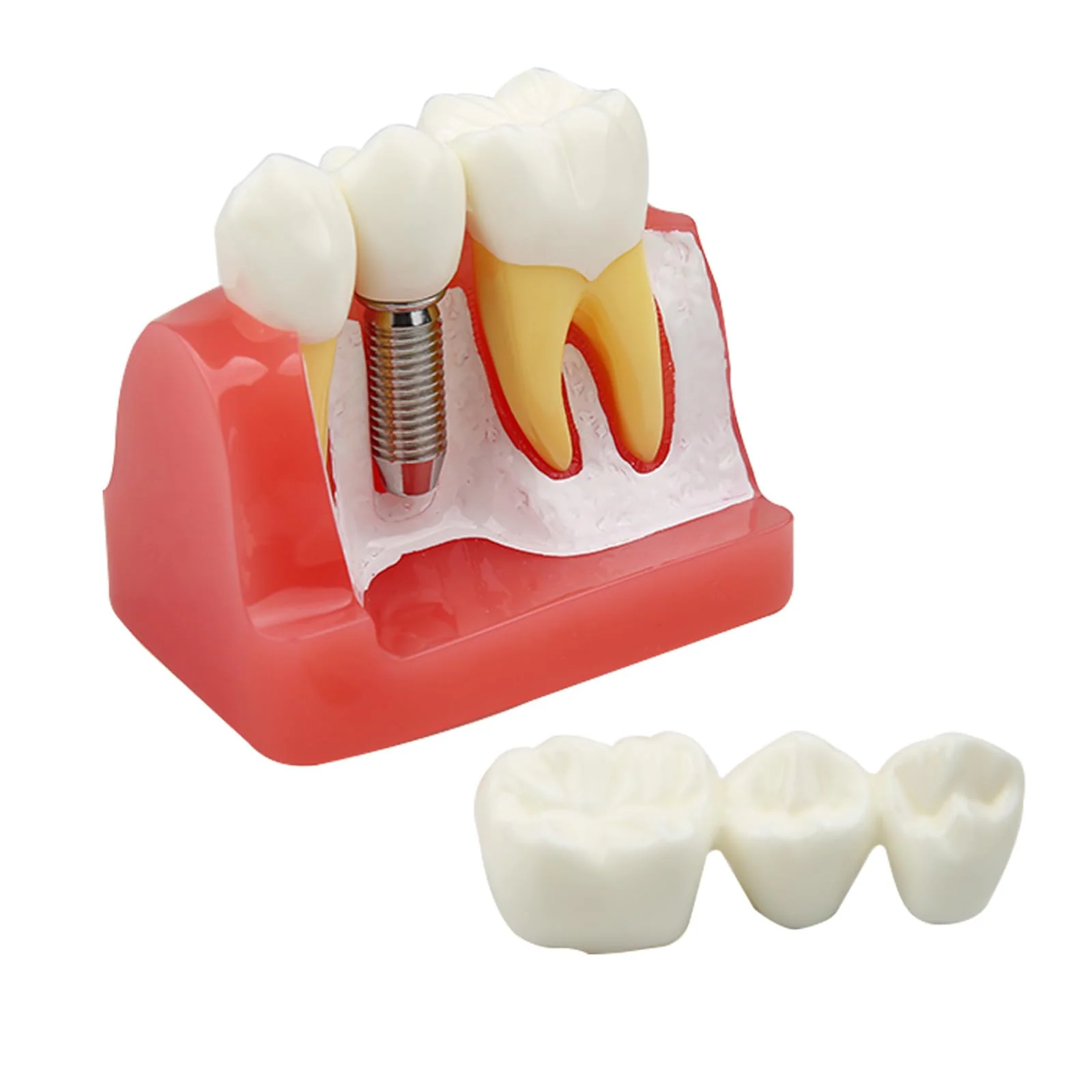 Dental Implant Model Removable Crown Bridge 4 Teeth Demonstration Model for Teaching Demonstration, Patient Education and Student Learning - Image 6