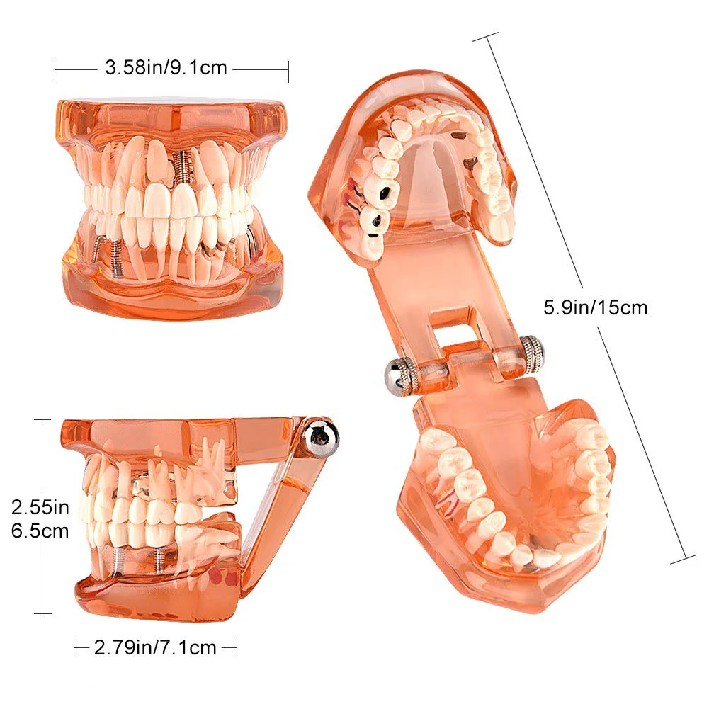 Dental Model for Teaching, Dental Degeneration Model Demonstration Study Orange Model Dentures - Image 2