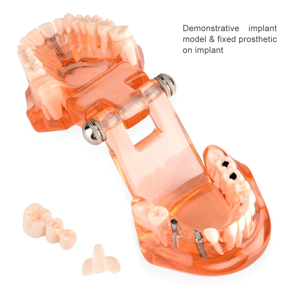 Dental Model for Teaching, Dental Degeneration Model Demonstration Study Orange Model Dentures - Image 3