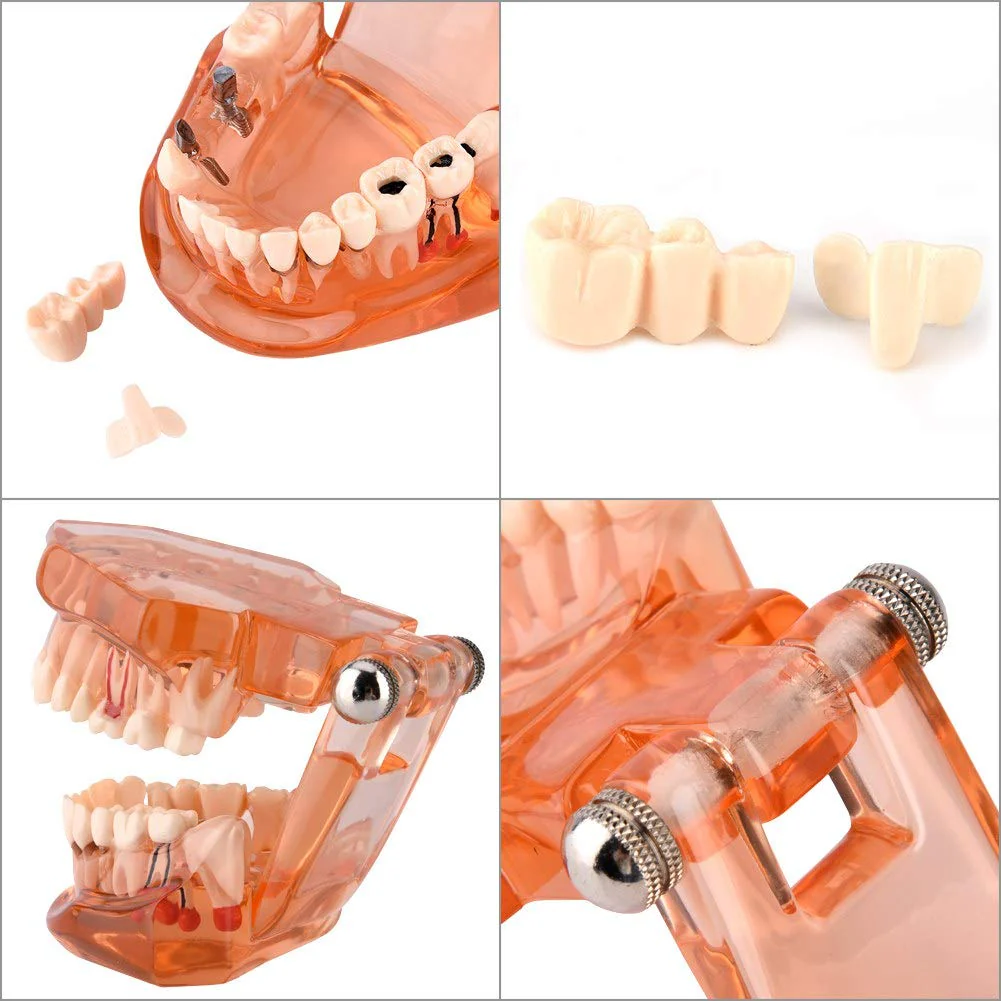 Dental Model for Teaching, Dental Degeneration Model Demonstration Study Orange Model Dentures - Image 4