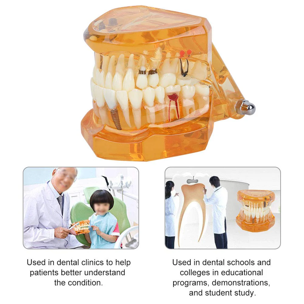 Dental Model for Teaching, Dental Degeneration Model Demonstration Study Orange Model Dentures - Image 5