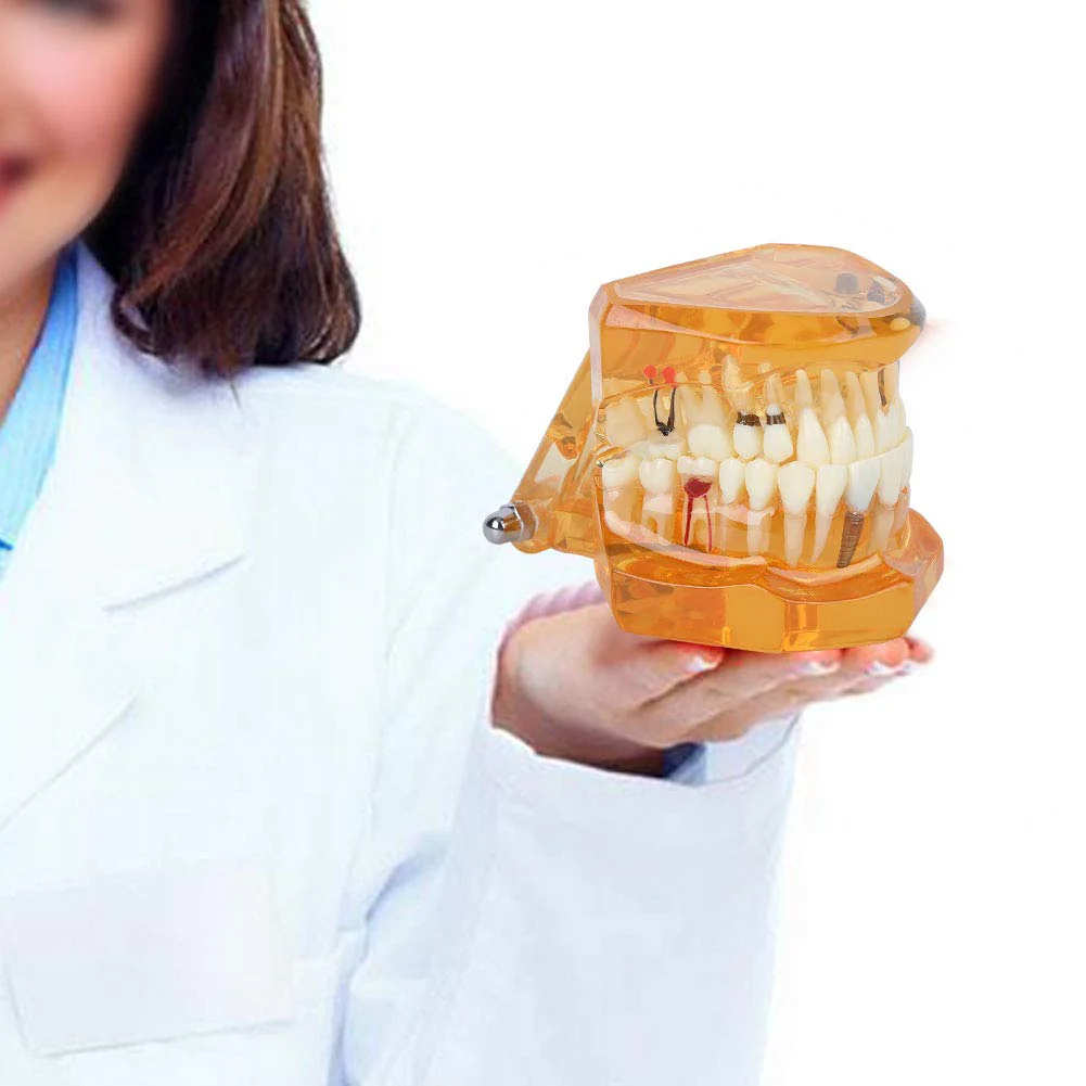 Dental Model for Teaching, Dental Degeneration Model Demonstration Study Orange Model Dentures - Image 6