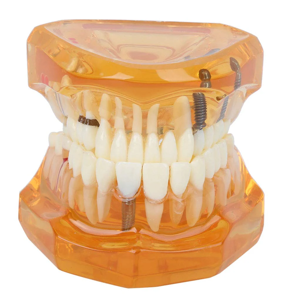 Dental Model for Teaching, Dental Degeneration Model Demonstration Study Orange Model Dentures - Image 7