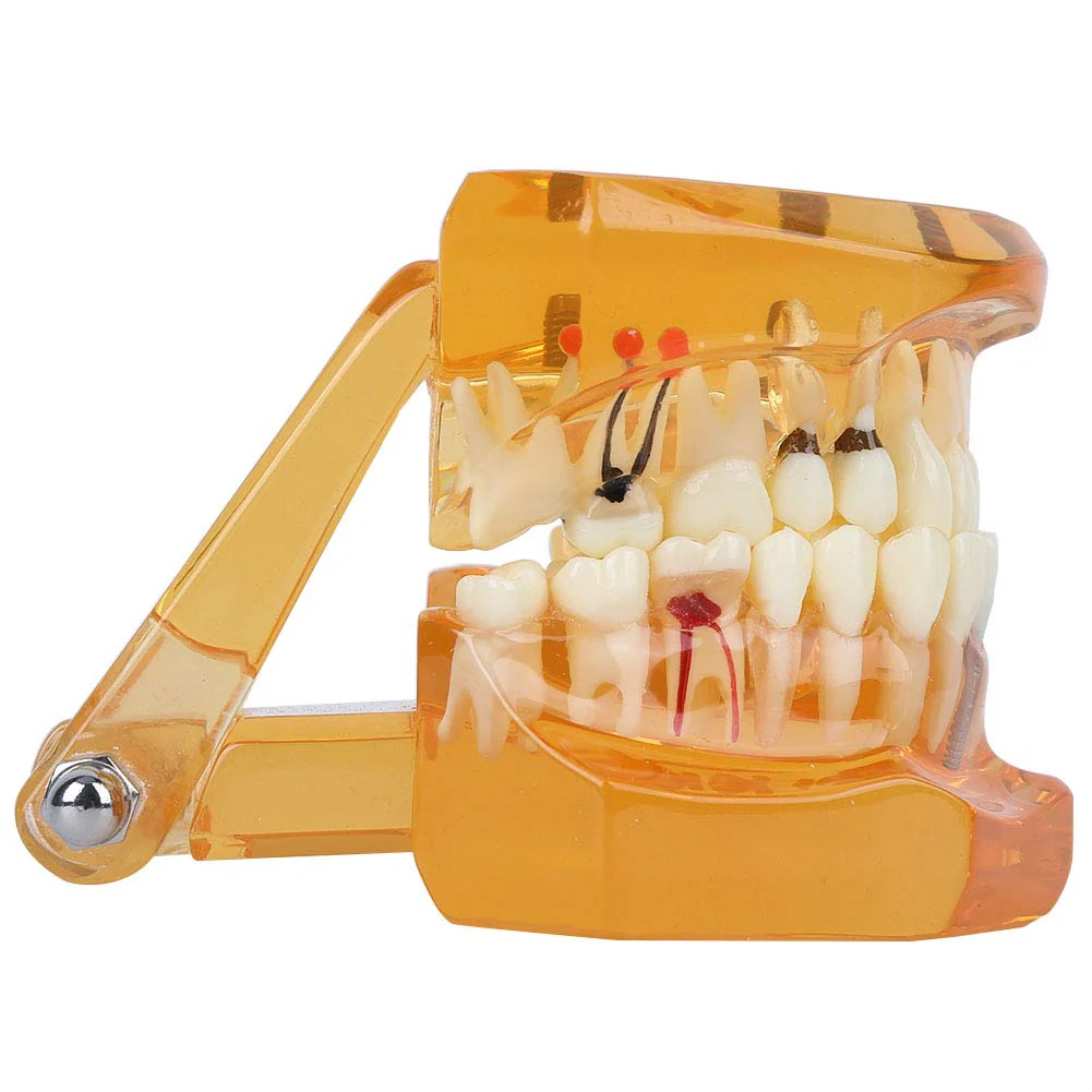 Dental Model for Teaching, Dental Degeneration Model Demonstration Study Orange Model Dentures - Image 8