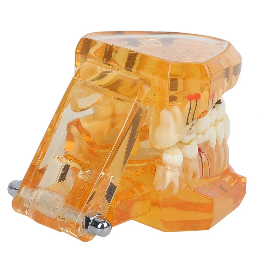 Dental Model for Teaching, Dental Degeneration Model Demonstration Study Orange Model Dentures - Image 9