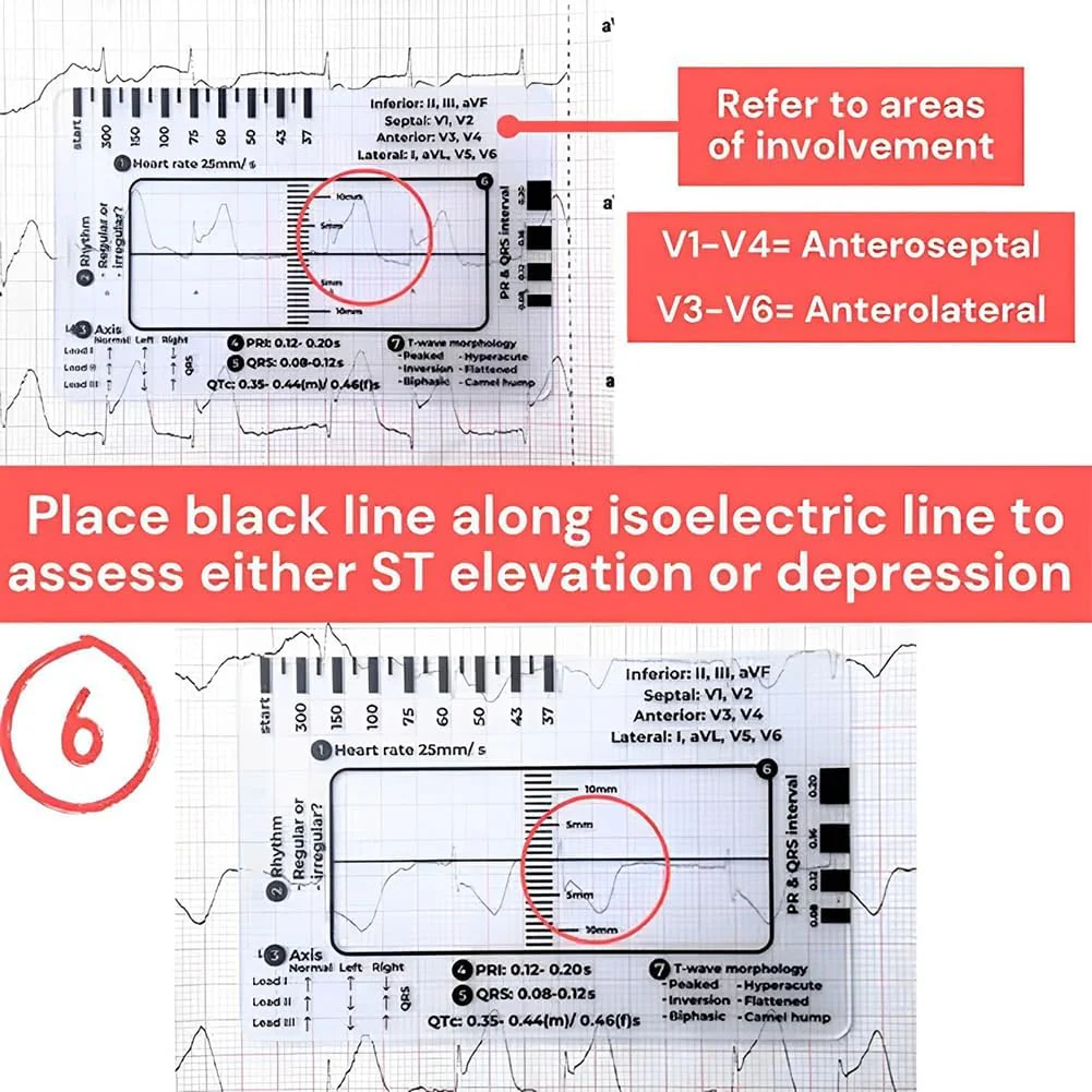 ECG 7 Step Ruler, ECG 7 Step Ruler for ECG/EKG Interpretation, ECG Ruler Plastic Ruler Measuring Tool, ECG Ruler Transparent, ECG Ruler Pocket etcard, Easy-to-Carry ECG Ruler (2 Pieces (with box)) - Image 7