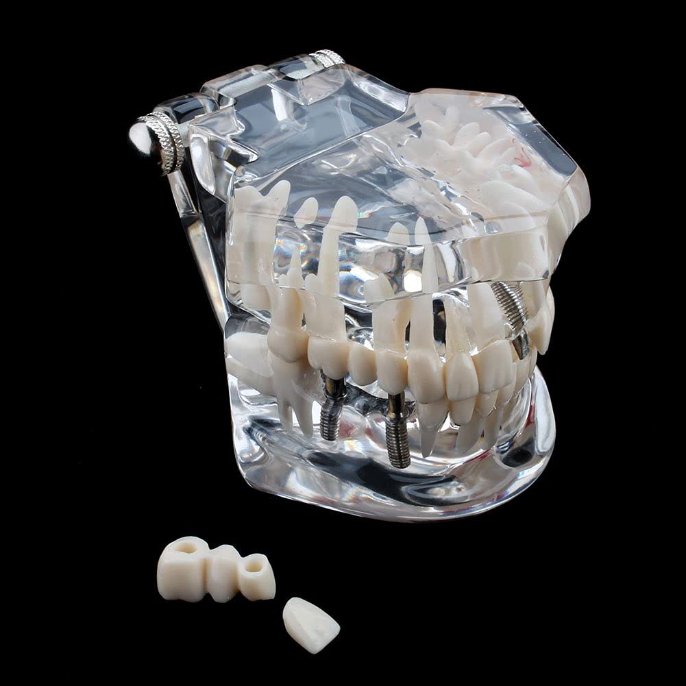 Model of Dentist Training, Dental Implant Disease Teaching Study Analysis Adult Typodont Demonstration Teeth Model New - Image 8