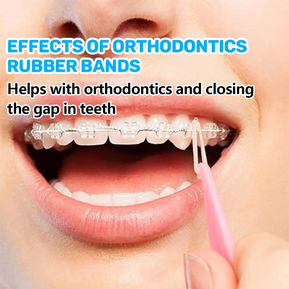 Orthodontic Rubber Bands, Pack of 300 Elastic Teeth Elastic Bands with 5 Placers for Braces, 5/16 Inch Orthodontic Elastics for Braces Dreadlocks Tooth Gap Braces - Image 2
