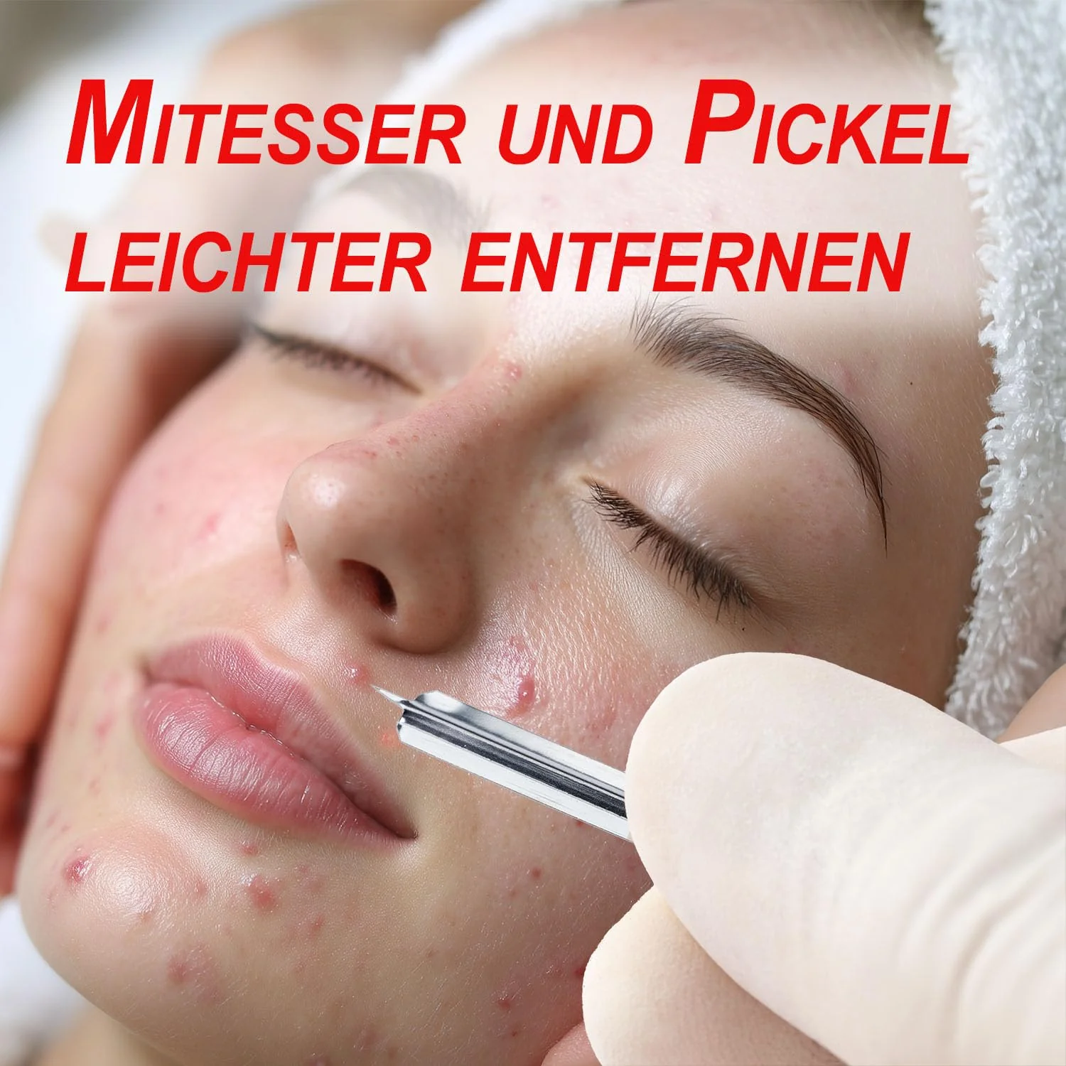 Pack of 100 Milien Lancets I Pimple Remover I Milia Remover Painless I Sterile Lancets Cosmetics I Blackhead Remover I Lancets Pimple I Individually Sterile Packed (100) - Image 3