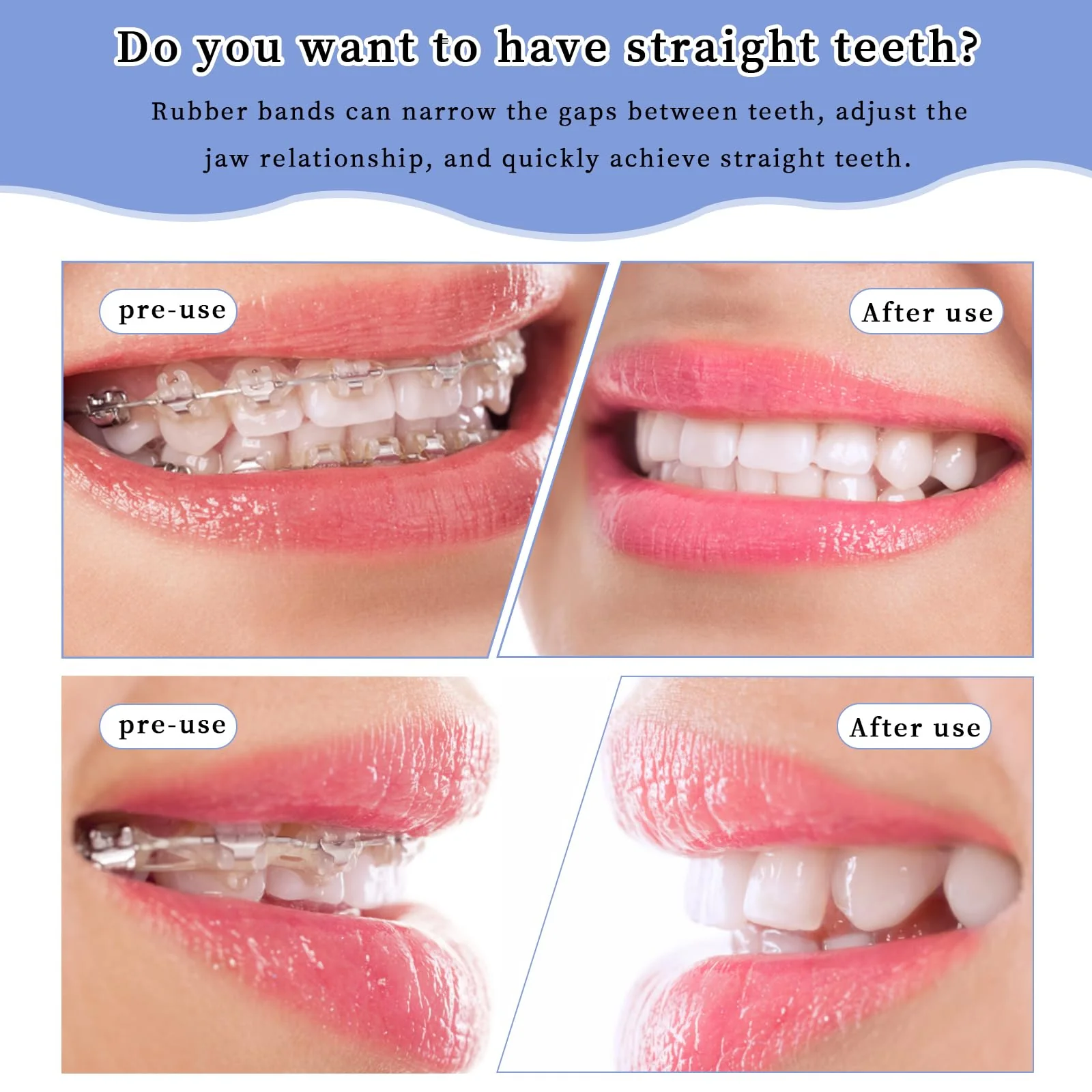 Pack of 500 Rubber Braces, Orthodontic Elastic, Orthodontic Latex Elastics, with 5 Pieces Placements, Suitable for Braces, Gaps and Crooked Teeth (Fox 1/4 Inch) - Image 3