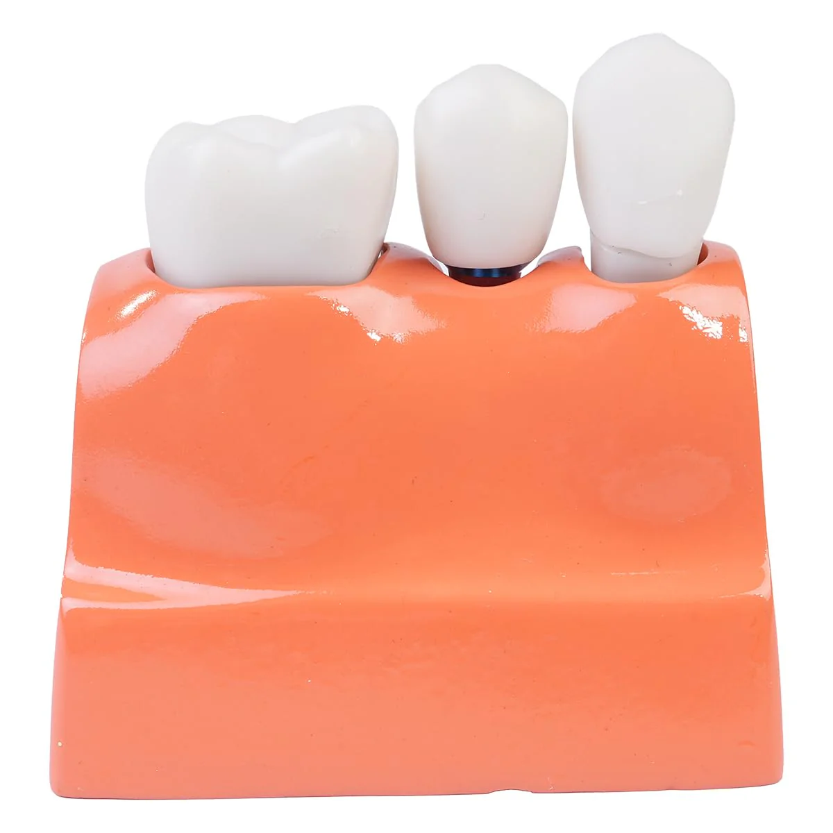 Sarini Oral Dental Model, Dental Implant Model with Removable Crown and Bridge, Suitable for Classroom Demonstrations and Dental Student Training - Image 3