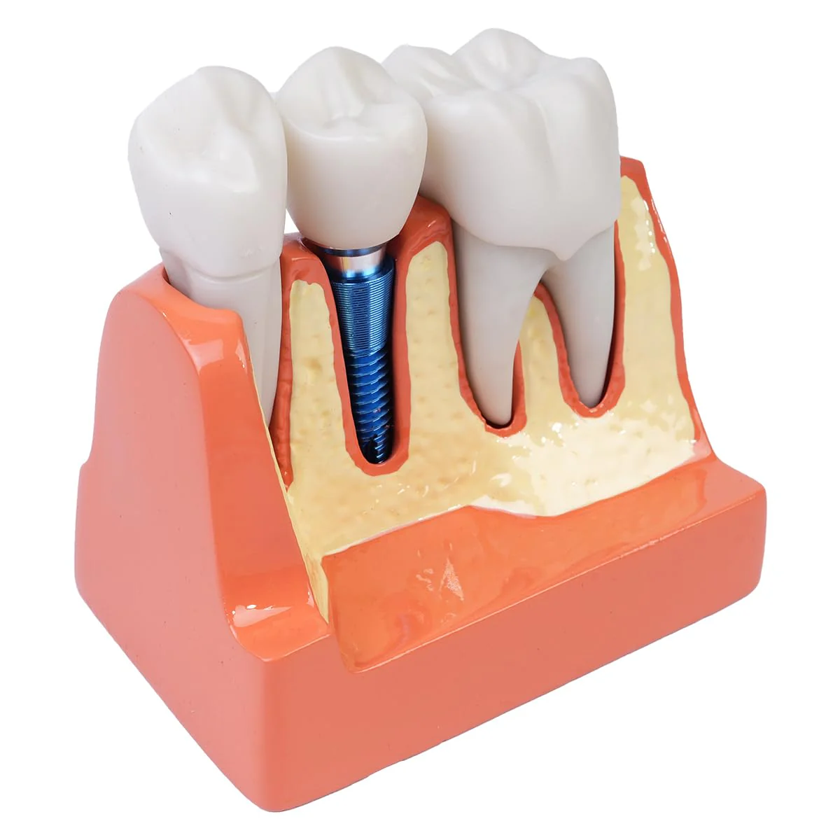 Sarini Oral Dental Model, Dental Implant Model with Removable Crown and Bridge, Suitable for Classroom Demonstrations and Dental Student Training - Image 4