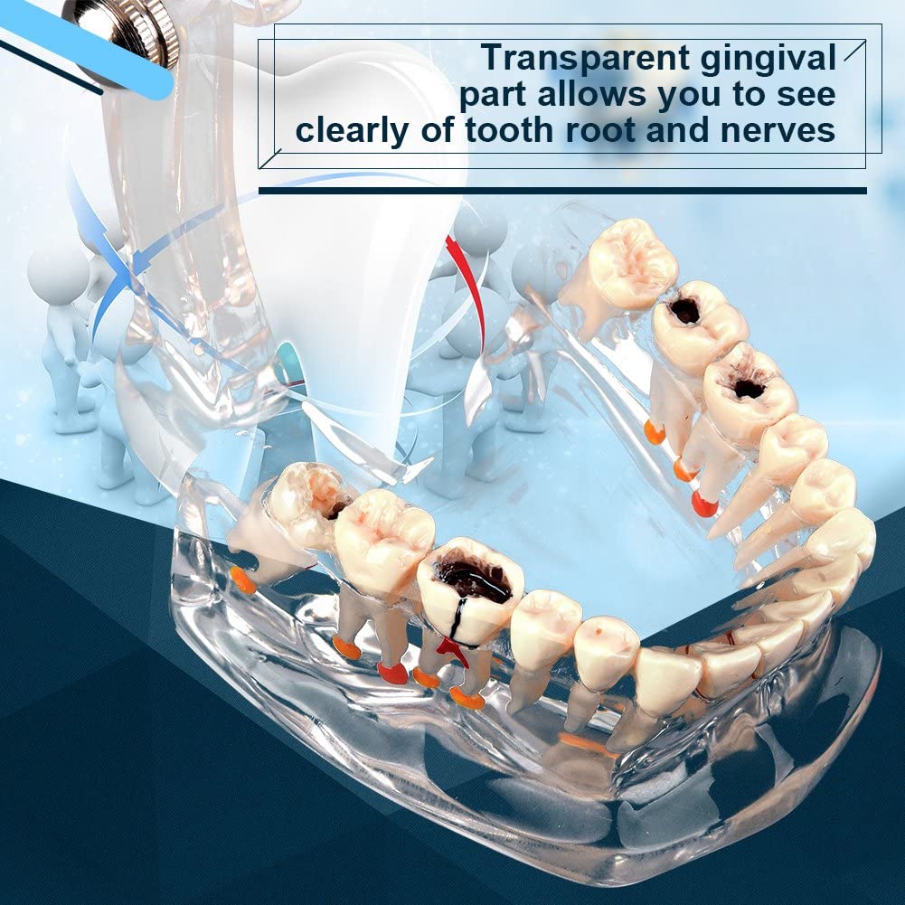 Walfront Model with removable teeth, transparent, implant, disease, teaching, standard teeth, model pathological demonstration - Image 2