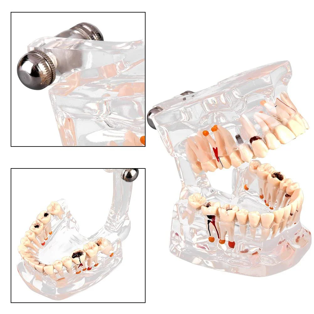 Walfront Model with removable teeth, transparent, implant, disease, teaching, standard teeth, model pathological demonstration - Image 4