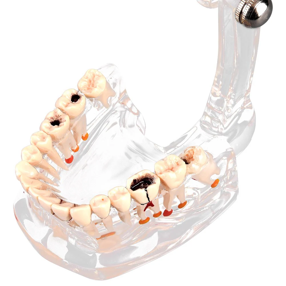 Walfront Model with removable teeth, transparent, implant, disease, teaching, standard teeth, model pathological demonstration - Image 5