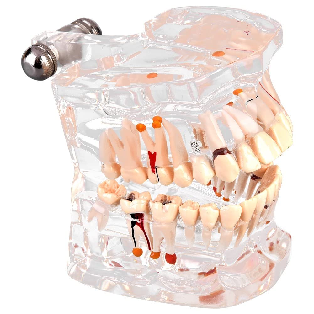 Walfront Model with removable teeth, transparent, implant, disease, teaching, standard teeth, model pathological demonstration - Image 7